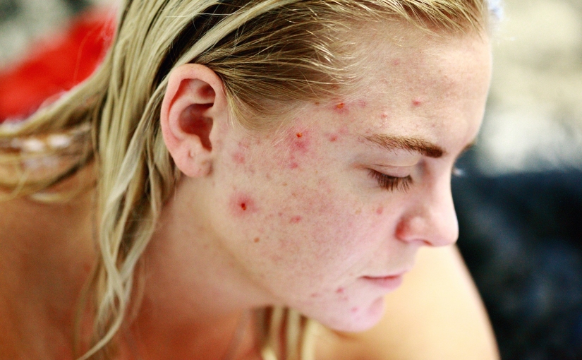 CBD Oil for Acne: What You Need to Know